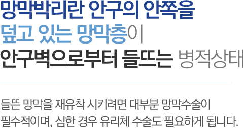 망막박리란 안구의 안쪽을 더 폭 있는 망막층이 안구벽으로부터 들뜨는 병적상태 - 들든 망막을 재유착 시키려면 대부분 망막수술이 필수적이며, 심한 경우 유리체 수술도 필요하게 됩니다.