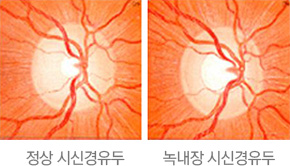 정상 시신경유두와 녹내장 시신경 유두